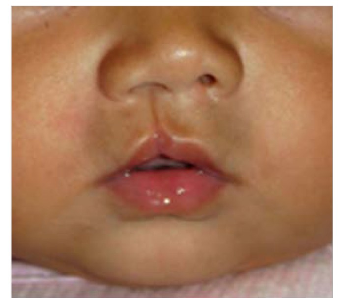 Hesi case study cleft lip