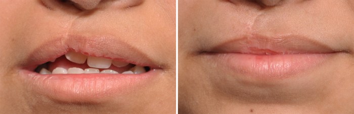 Hesi case study cleft lip