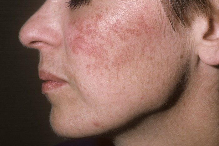 Rosacea fatty acne face chinese intake influenced dairy risk food population assessed intention investigators diet among possible between link large