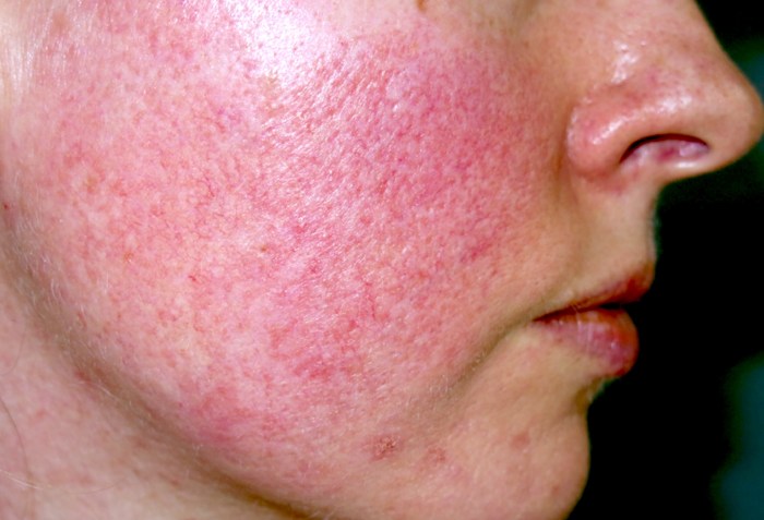 What is commonly called couperose skin