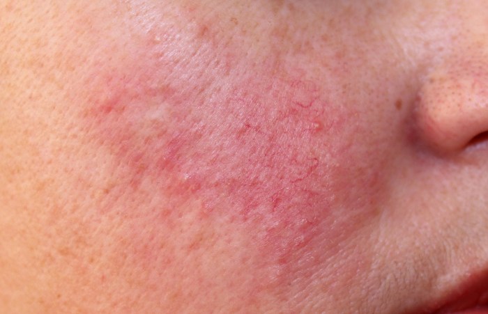 Rosacea