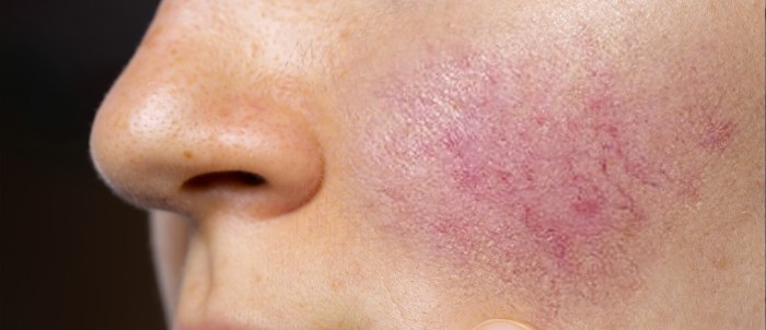 What is commonly called couperose skin